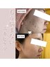 【リピート続出】ニキビにお悩みの方へ・・♪超音波最先端ケア◎¥5800