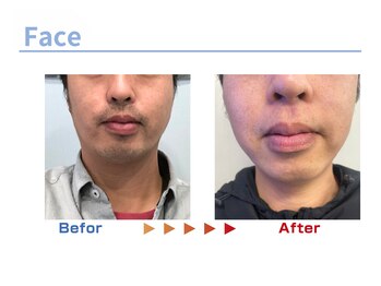 キングスサロン 熊本/メンズ髭脱毛ビフォーアフター