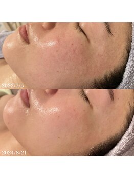 リリアス(RILLIAS)/毛穴ケア