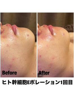 Sスタイルスタジオ 福岡天神/エレクトロポレーション1回目