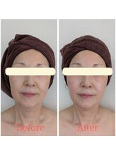 エミニー バイ エルズ(Eminy by L★s)/60代　小顔コルギ　2回