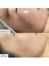 ユイット ルッカ(Huit Lucca)/ララピール×アクアダーマ