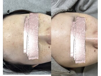 モガナ(mogana)/20代・シミケア半年パスポート