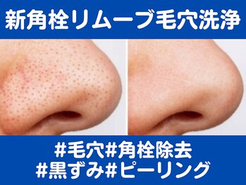 オリエンタルローザ 表参道(Oriental Rosa)/新角栓リムーバー！毛穴を除去！