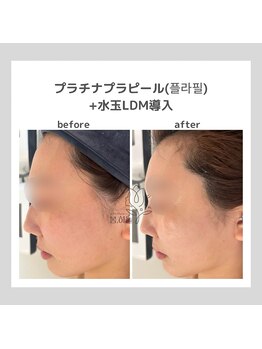 韓国肌管理室pom.haneul【ポムハヌル】LDM/インモード/ララピール/プラピール福岡天神/韓国肌管理室