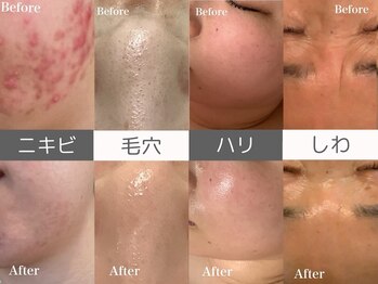 トウメイコガオ 横浜店の写真/ダウンタイムなしで速攻ケア！内側から輝く透明感と肌質改善を最新韓国肌管理で実現♪