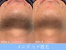 【メンズ脱毛】青髭解消★髭剃り卒業!ヒゲ脱毛体験 1回¥8800→¥ 980