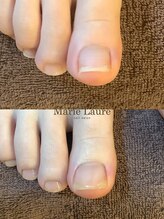 マリーロール 梅田店(Marie Laure)/自爪育成/深爪矯正/ネイルケア