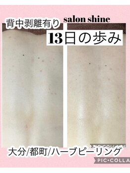 サロンシャイン(Salon Shine)/背中のハーブピーリング