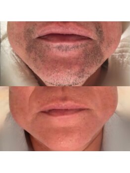 メンズサロンエヌエー(MEN'S SALON NA)/【頑固なヒゲもお任せ】ヒゲ脱毛