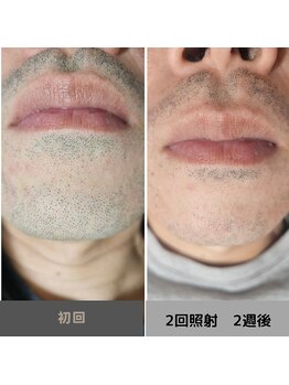 キムラケ 和光別邸(木村家 KIMURAKE)/メンズ脱毛ヒゲビフォーアフター