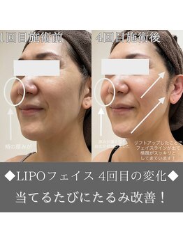 ナンバーファイブクリニカルサロン 札幌店(No.5)/BeforeAfter/たるみ改善