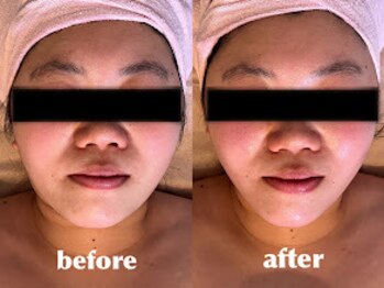 エステティックサロン フェアリー(ESTHETIC SALON FAIRLY)/Vリフト小顔矯正Before→After