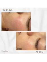 ホワイトラボ 梅田(White labo)/【施術例】ハイドロフェイシャル