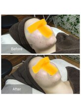 リラーナ(Re rana)/大人ニキビケア♪