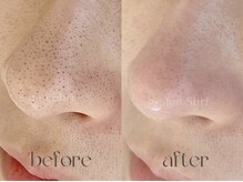 シュリ(Shri)/毛穴撃退フルコース