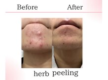 サロンツキ(salon tuki)/ハーブピーリング