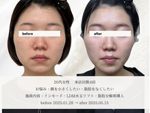 エメ(aimer)/LiftCare《小顔・リフトアップ》