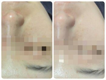 トータルビューティ ノイド(Noid)/毛穴洗浄　お試し全顔