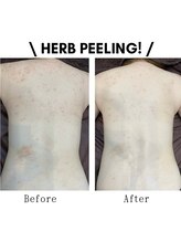 リファイン(Refine)/背中ハーブピーリング