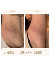 ガムラン(Gamelan)/ワキ脱毛　2年フリー（左側）