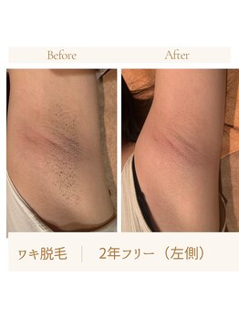 ガムラン(Gamelan)/ワキ脱毛　2年フリー（左側）