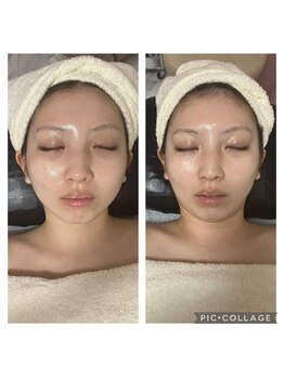 BBC 田園調布/小顔コルギ効果