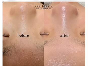 アン ビューティー(ann beauty)/施術1回【症例写真】中学生