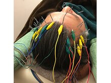 頭の電気鍼　(トウシン) 不眠の悩みや自律神経を整えていきます