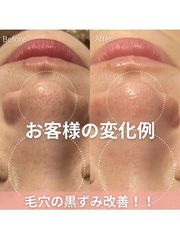 アイビーケア 三田(ivy care)/毛穴の黒ずみ、汚れ除去!