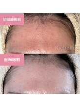 リシェル(Richelle)/ 【GREENPEELセンシダーム】