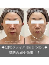 ナンバーファイブクリニカルサロン 札幌店(No.5)/BeforeAfter/小顔＆リフトアップ