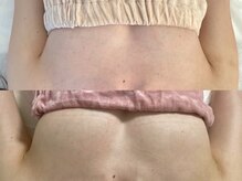 美人バスト 横浜店/バストアップ症例/育乳(6回施術)