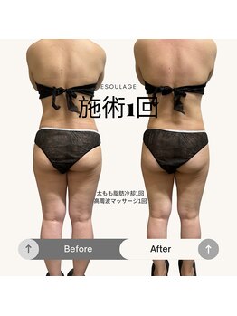 エスラージュ(esoulage)/脂肪冷却　太もも