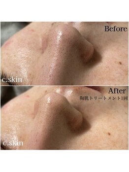 シースキン 盛岡駅前店(c.skin)/お客様ビフォーアフター