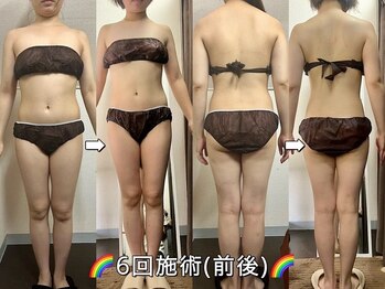 サロンドココ(Salon de COCO)/ハイパーナイフ/全身痩身/美背中