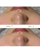 ホワイトラボ 姫路(White labo)/【施術例】ハイドロフェイシャル