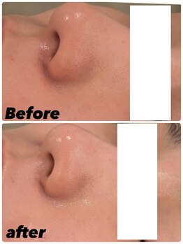 ルピナス(Lupinus)/施術4回/ くすみ、毛穴