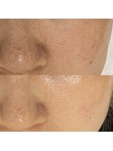 結(musubi)/ピーリング（XE'LHA Peel）