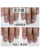 マニュコクーン(ManuCocoon)/爪育成　深爪　巻き爪　大阪市