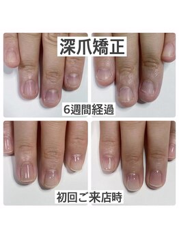マニュコクーン(ManuCocoon)/爪育成 深爪 巻き爪 大阪市
