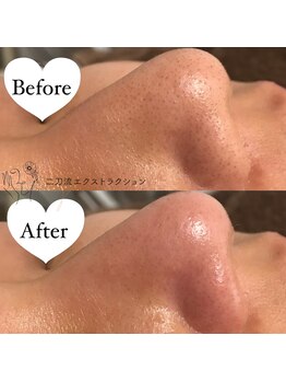 毛穴ケアサロン そらな/小さい毛穴もお任せください^ ^