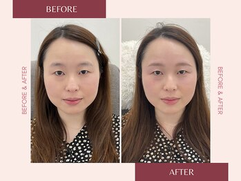 ナキ(Naki)/眉毛施術例 (眉毛Before.After)