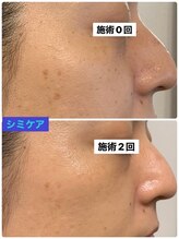 プリュネル(Prunelle)/シミケア&プラズマシャワー