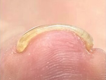 エース(A's)の写真/つらい巻き爪でお悩みの方必見！痛みや締め付けの少ない施術なので初めての方にもオススメです◎