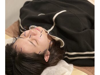 サンライズ鍼灸整骨院 石橋院/美容鍼