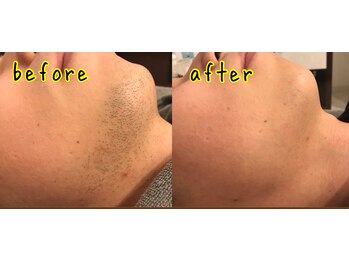 サンサン(SunSAn)/6回目の経過観察