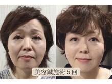 ライフサロン 天神(Life Salon)/美容鍼Before /After◎