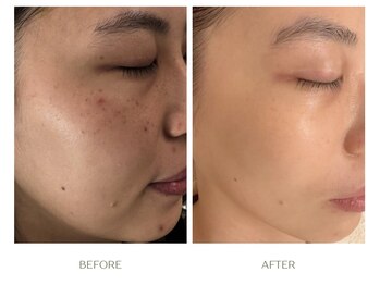 ラシェプリズ(LACHER PRISE)/シミケア・改善例