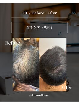 ビトウェルネス 池尻大橋(Bi to wellness)/育毛促進(ヒト幹細胞上清液)